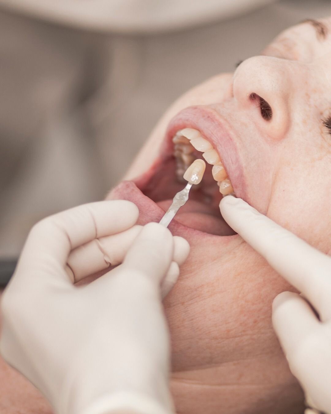 Tratamiento de Rehabilitación Oral en CLER Estudio Odontológico