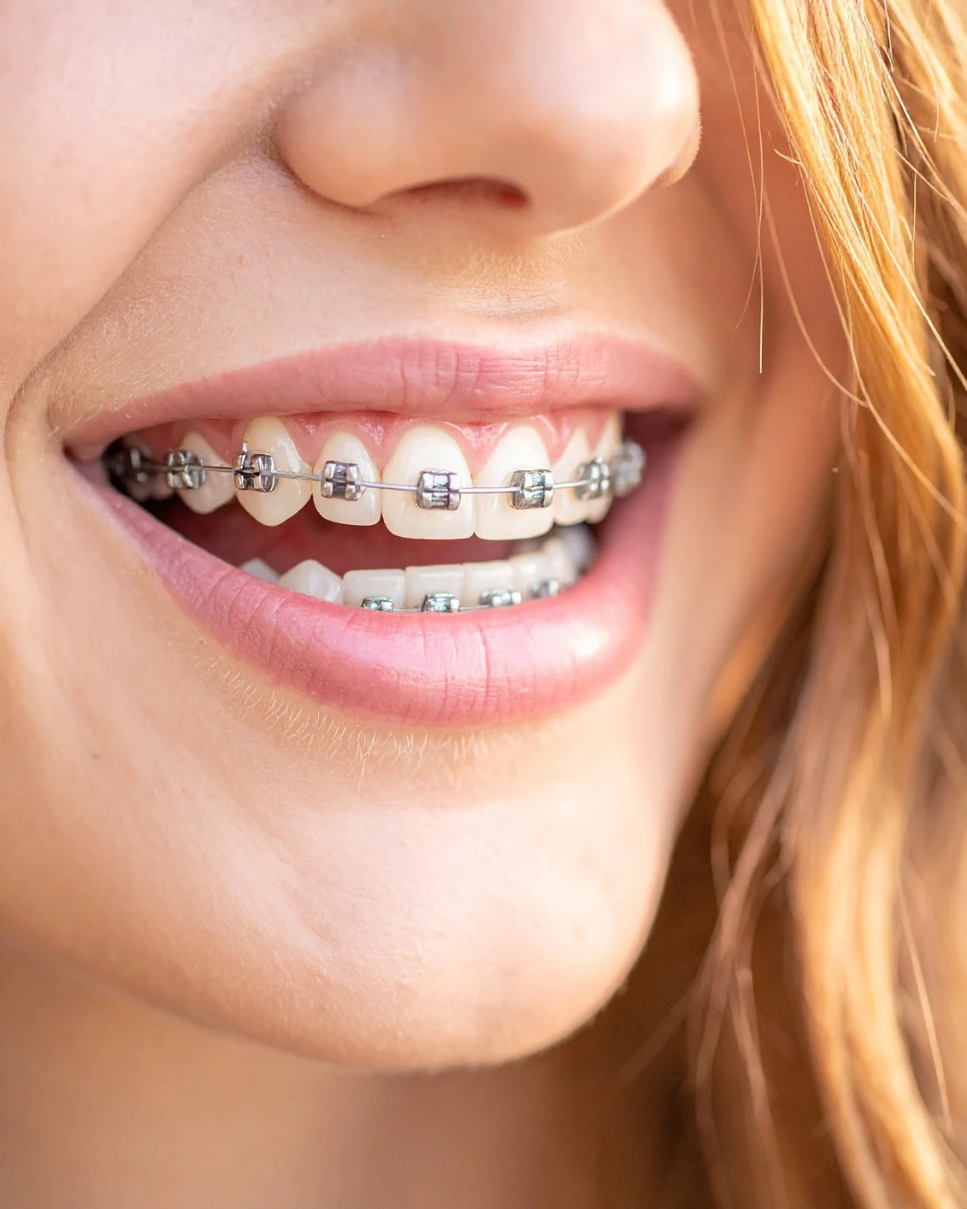 Tratamiento de Ortodoncia en CLER Estudio Odontológico